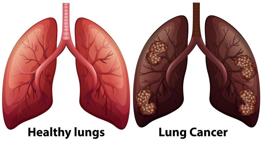 Human Anatomy of Lung Condition vector