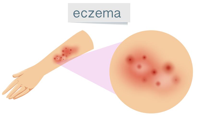 Un vector de eczema en la piel.