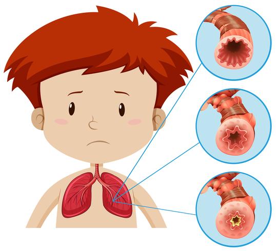 Una anatomía humana del problema pulmonar vector