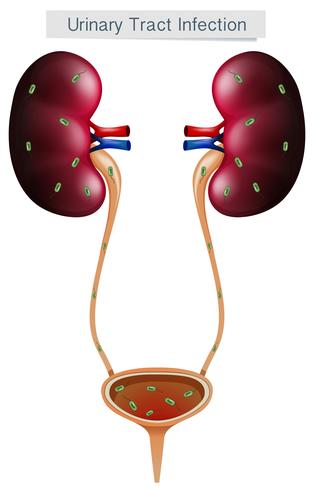 Infección del tracto urinario sobre fondo blanco vector