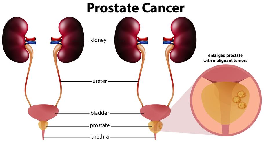 Cáncer de próstata sobre fondo blanco vector