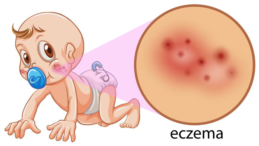 A Vector of Baby Having Eczema - Download Free Vector Art, Stock Graphics & Images