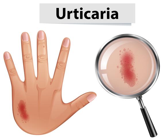 Urticaria magnificada en mano. vector