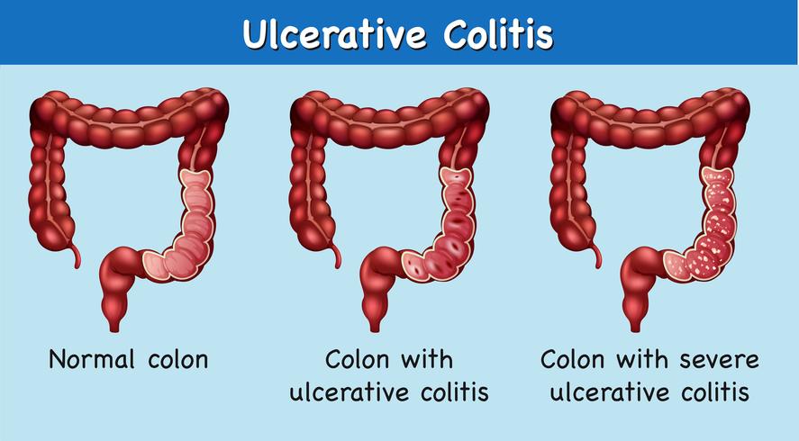 Diagrama que muestra la colitis ulcerosa vector