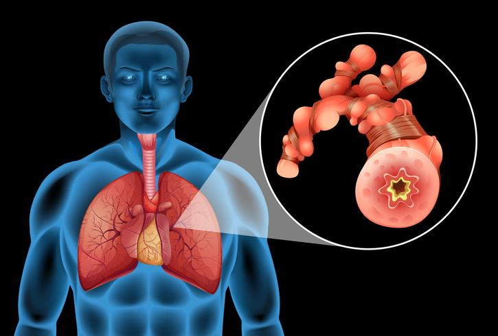 Human man with tumor in lungs vector