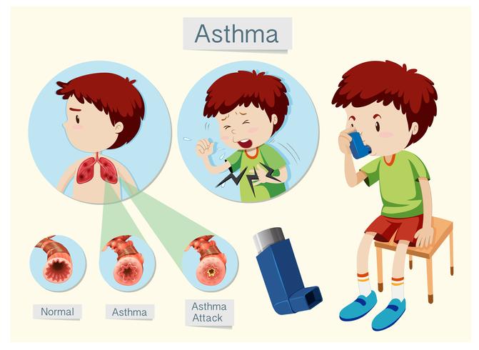 A Human Anatomy and Health Asthma vector