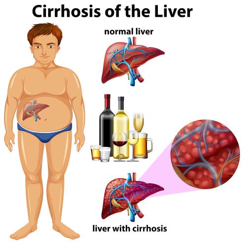 Cirrosis del higado vector