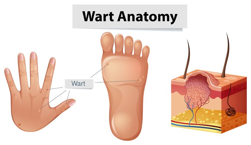 Anatomía humana verruga en manos y pies vector