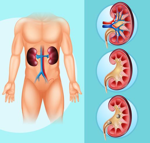 Human and kidney stones vector