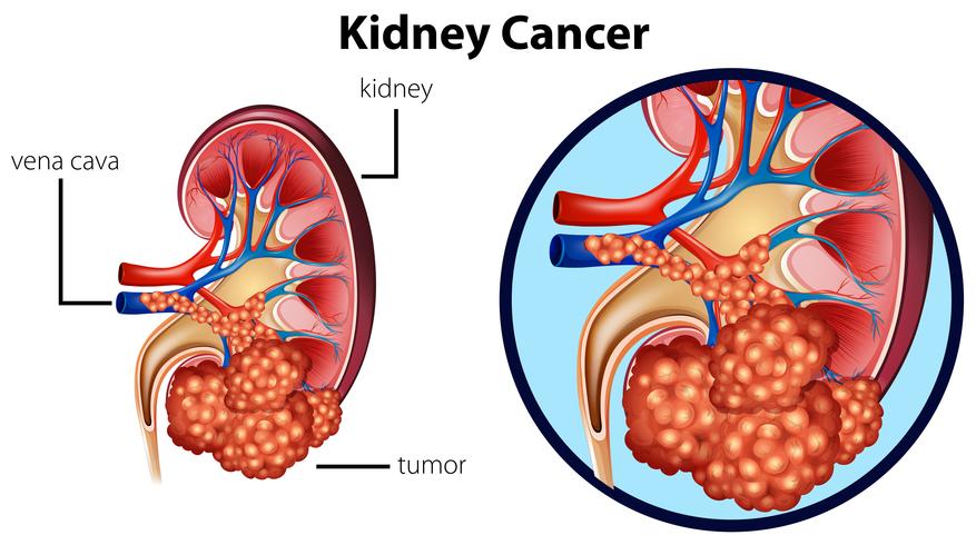 Diagram showing kidney cancer vector