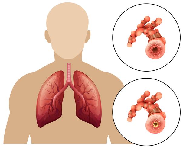 Enfermedad Pulmonar Obstructiva Crónica Humana vector