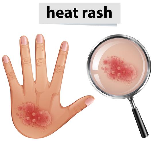 Mano humana con sarpullido por calor vector