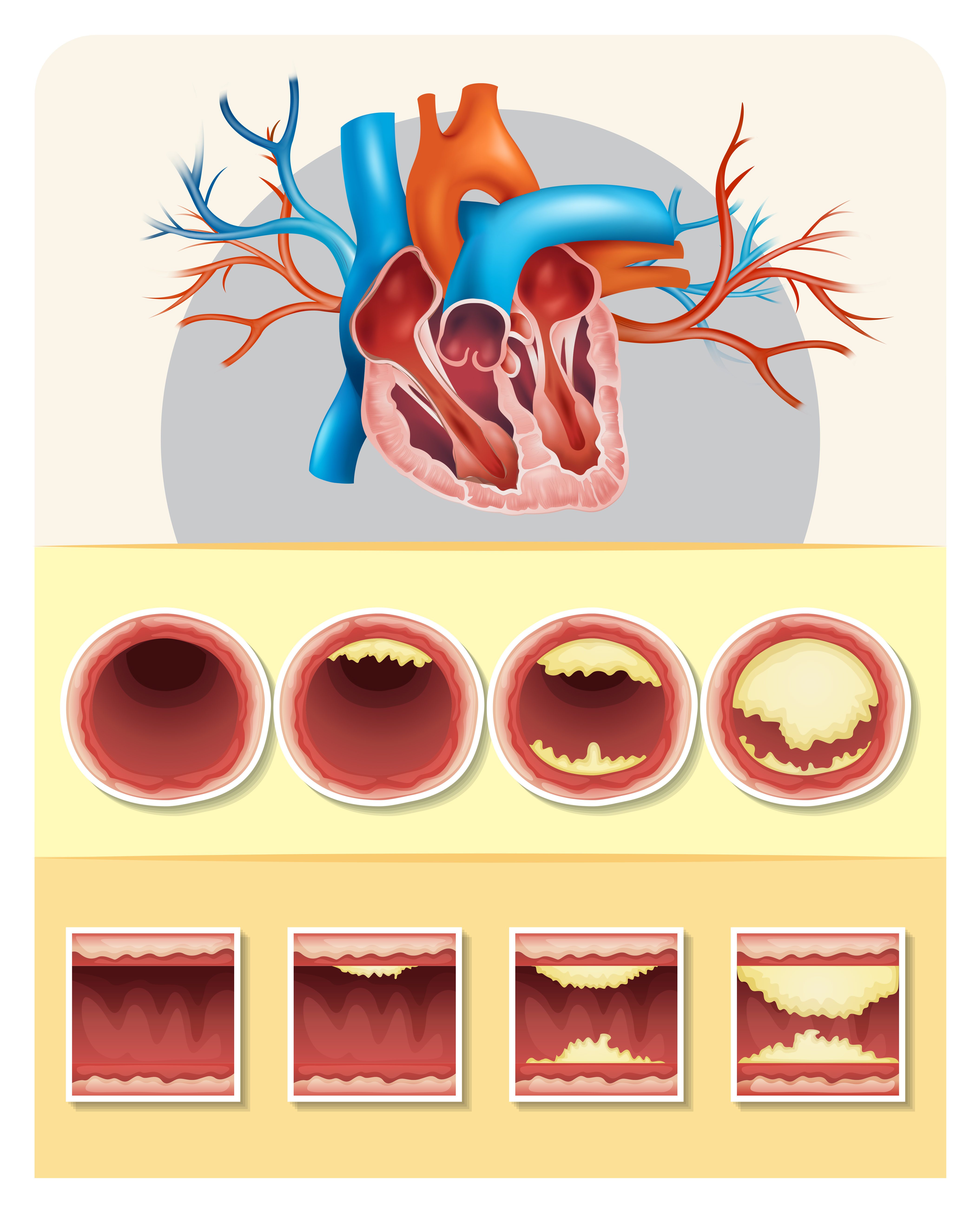 Download Diagram showing fat in human heart 303905 - Download Free ...