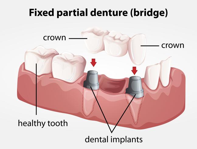 Puente de dentadura parcial fijo. vector