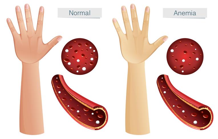 Human Anatomy Vector of Anemia