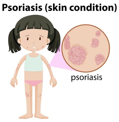 Una niña con psoriasis en la piel vector