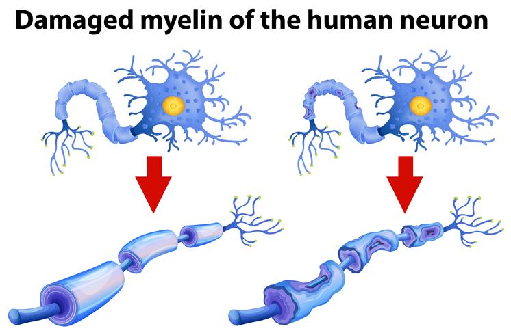 Mielina dañada de la neurona humana vector