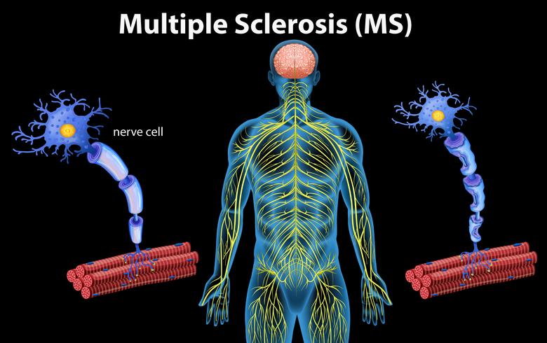 Anatomía humana de la esclerosis múltiple vector