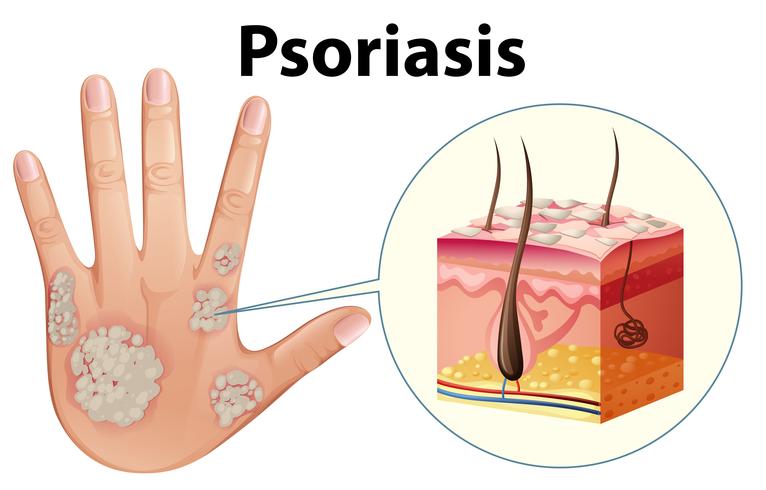 Diagrama que muestra la psoriasis en la mano humana vector