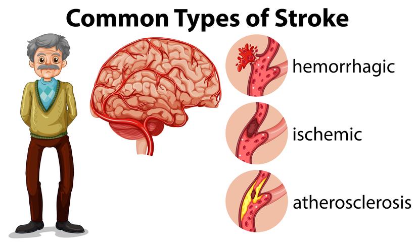 And Old Man and Types of Stroke vector