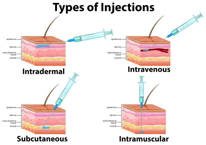 Un conjunto de tipo de inyecciones vector