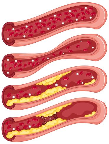 Diagram showing blood clot in human veins vector