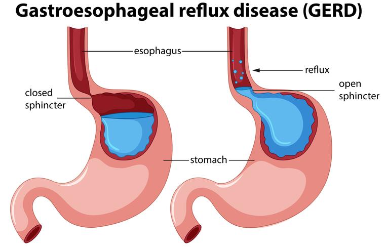 Gastroesophageal reflux disease anatomy vector