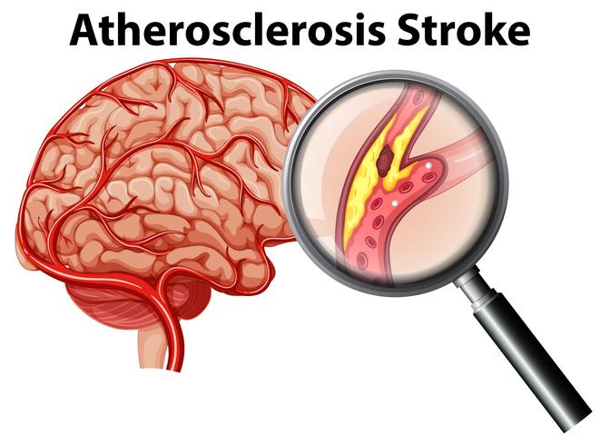 Trazo de aterosclerosis sobre fondo blanco vector