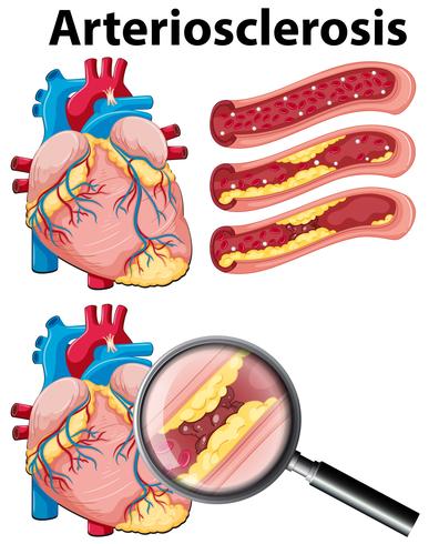 Un corazón con arteriosclerosis sobre fondo blanco vector