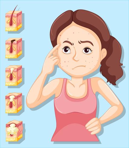 Woman and pimple problems vector