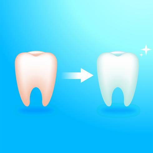 Diente sucio y limpio. Tratamiento en el dentista. Dolor en los dientes. Vector realista ilustración