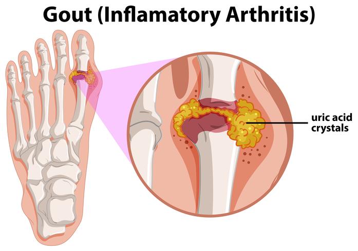 Diagram showing gout in human foot vector