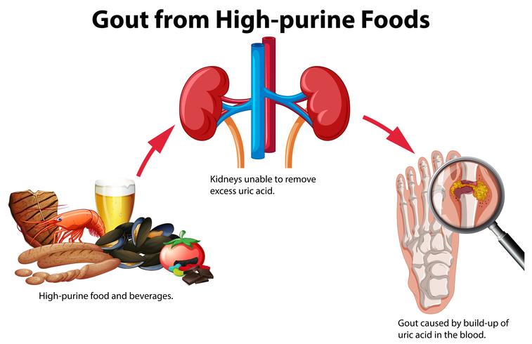 Gout from High-purine Foods vector