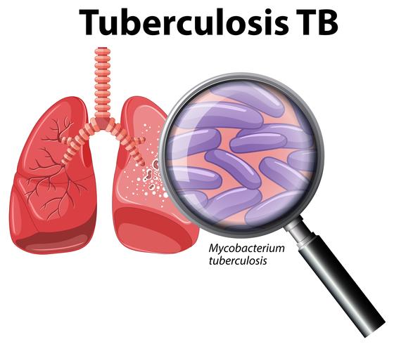 Pulmón humano con tuberculosis vector