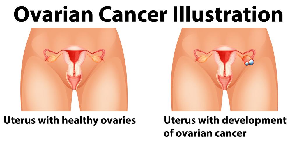 Diagram showing ovarian cancer in human vector