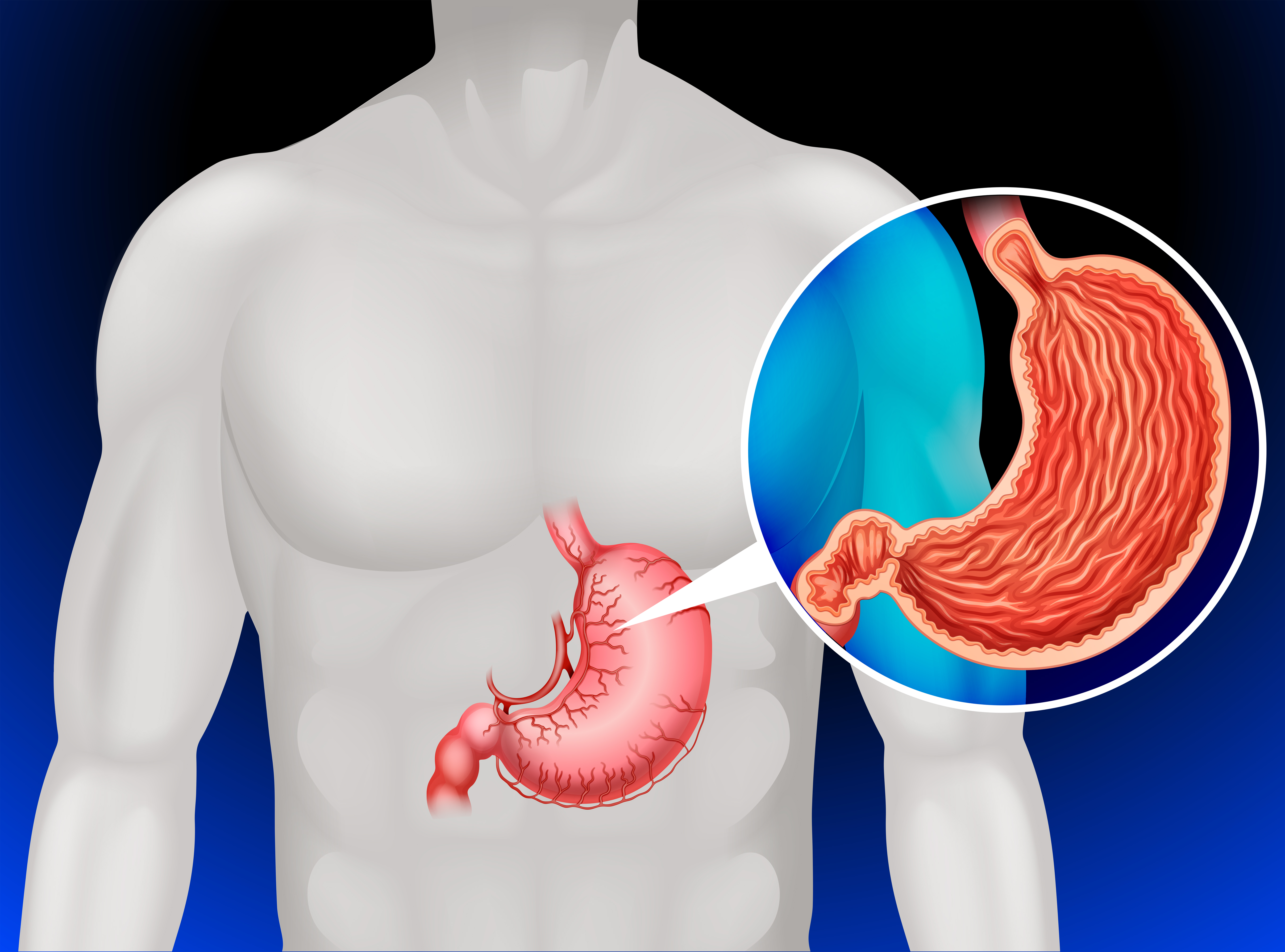 Stomach cancer in human 365470 Vector Art at Vecteezy