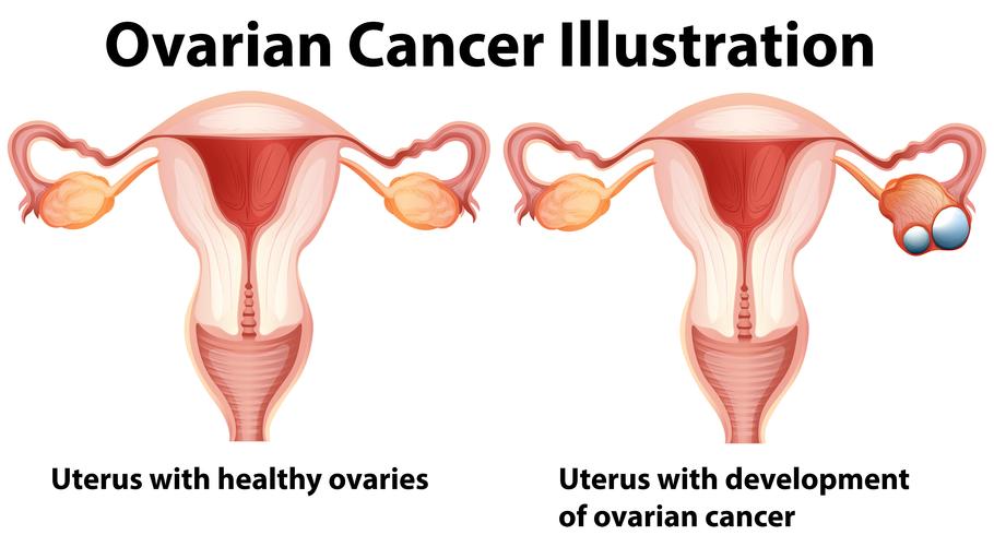 Healthy and unhealthy ovaries in woman vector