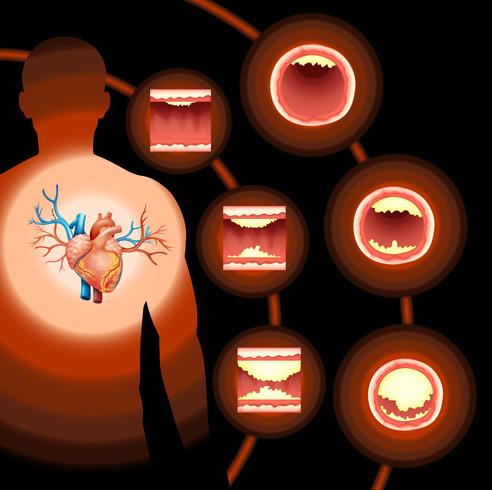Heart cholesterol in human body vector