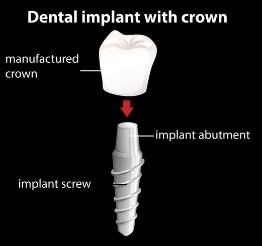 Un implante dental con corona. vector