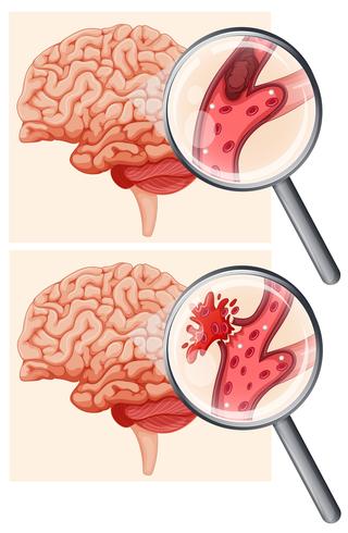 Cerebro humano y accidente cerebrovascular hemorrágico vector