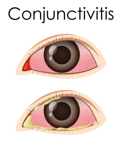 Diagram showing conjunctivitis in human vector