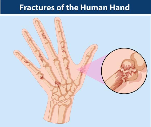 Diagrama de fracturas en mano humana. vector