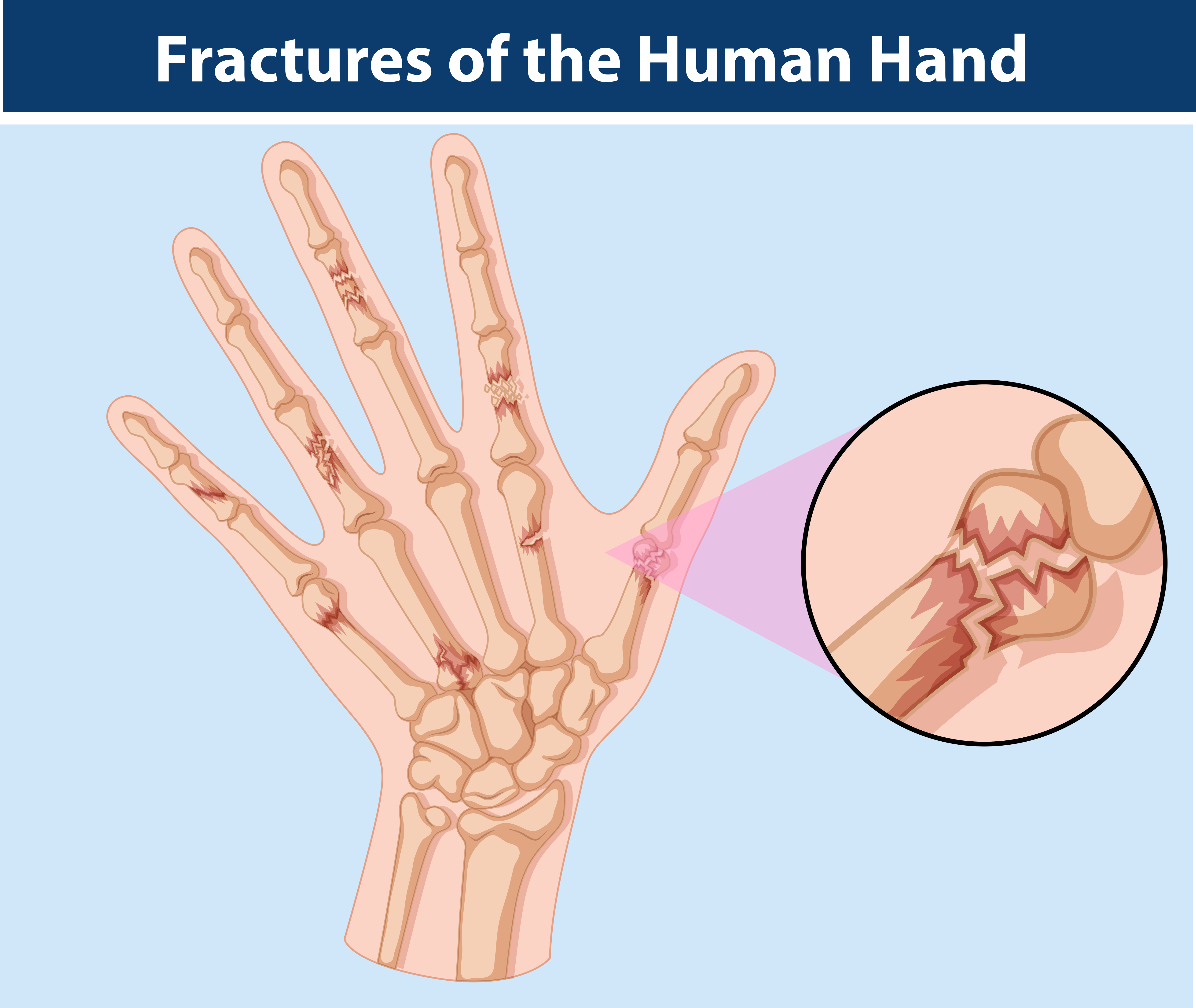 Diagram of fractures in human hand 373922 Vector Art at Vecteezy