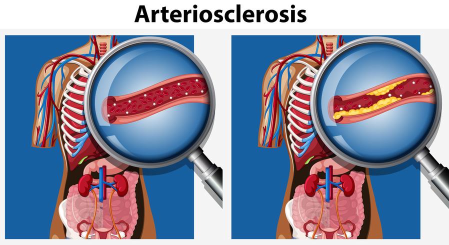 Human Anatomy with Arteriosclerosis vector