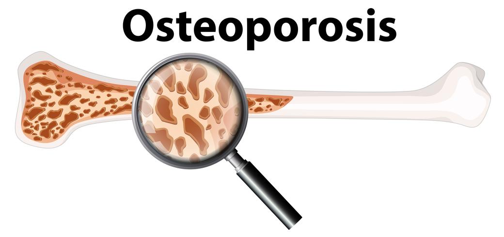 Osteoporosis and Magnifying Glass  vector