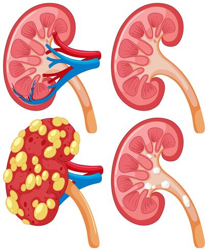 Diagram of kidney with disease vector