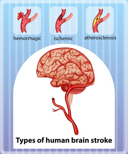 Types of human brain stroke vector