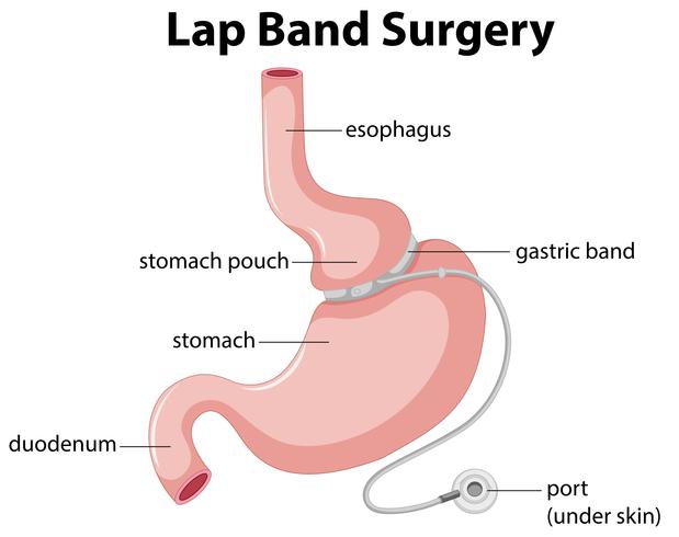 Lap Band Surgery Diagram vector