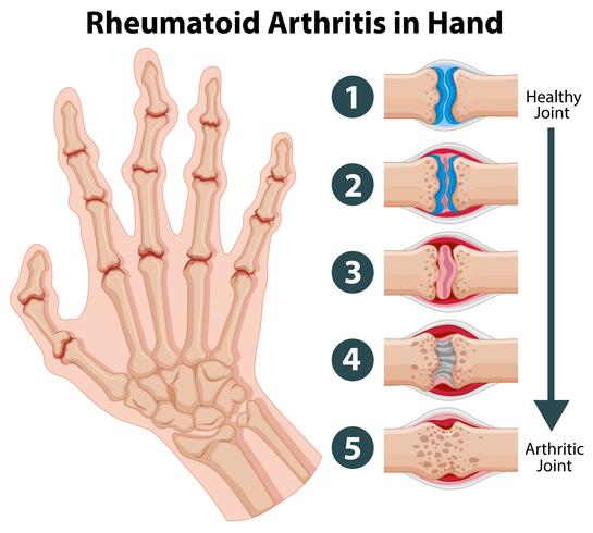 Diagrama que muestra artritis reumatoide en la mano. vector