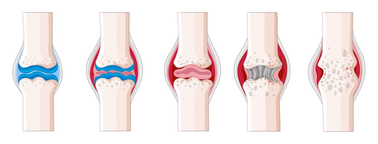 Rheumatoid arthritis in human body vector